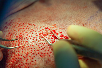 Patient's head close-up. Baldness treatment. Hair transplant. Surgeons in the operating room carry...