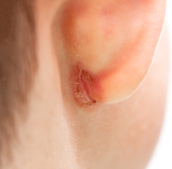 wound in the ear of a child