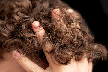 burnt hair on his head