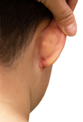 Obraz premium wound in the ear of a child