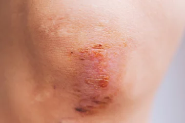 Tuinposter Scar and scab (eschar) on asian female knee © lzf