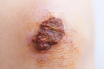 Fotobehang Scar and scab (eschar) on asian female knee © lzf