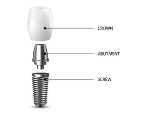 Vector 3d Realistic Render White Tooth Implant Denture Closeup Isolated on White Background. Dental, Medicine and Health Concept. Design Template of Prosthesis Structure. Front View