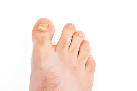 A young males foot infected with toenail fungus on a white Background.