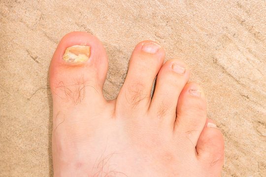 A young males foot infected with toenail fungus with a tile floor background - close-up.