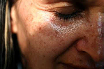 Pigmented spots on the face. Pigmentation on cheeks