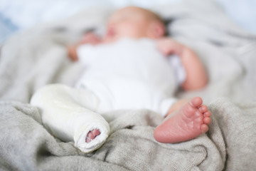 Closeup of newborn little baby with leg in a cast - clubfoot