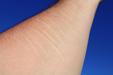 The scars from the knife on the arm. Close-up. Background.