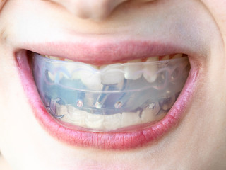 plastic orthodontic trainer for bite correction