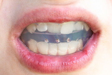 orthodontic trainer for bite correction close up