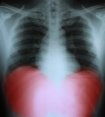 Xray of a human thorax with Stomach highlighted in red