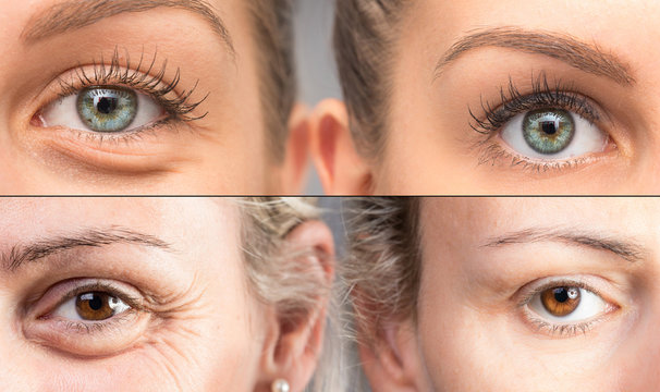 Comparison between woman eye bags before and after cosmetic treatment