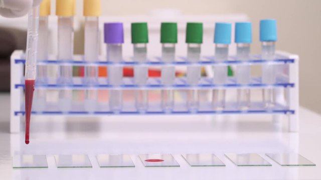 A close-up of a lab technician dripping red blood with a pipette on microscope slide glasses for testing, blood test, complete blood count (CBC) in medical laboratory. Test tubes on background