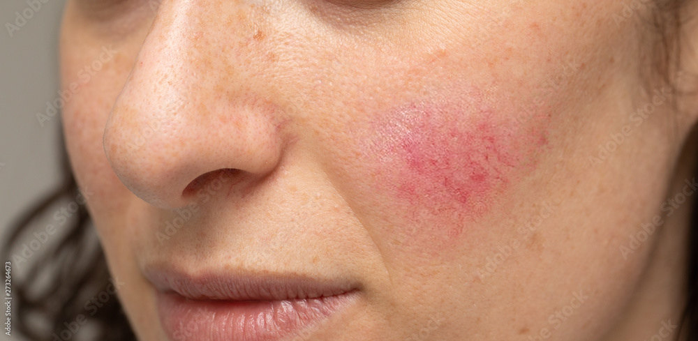 Wall mural woman with blotchiness on the cheek caused by bacterial infection