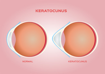 eye cornea and keratoconus vector / anatomy