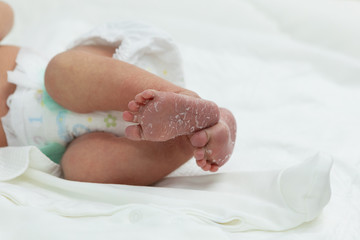 Baby feet with flaky skin. Newborn baby in maternity hospital close-up. Problems with the skin of a newborn baby in the first days of life