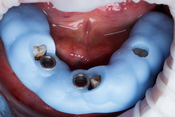 blue surgical pattern from polymer in patient's mouth before precise implantation