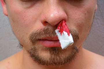 Bleeding from the nose of a young guy. Blood pressure in men. White napkin in the man's nose. Stop...