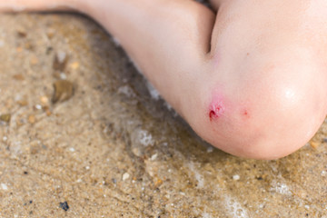 Blood from a wound on a child's knee. Slight bruise on the boy's leg.