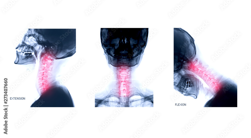 Aufkleber x-ray c-spine or x-ray image of cervical spine lateral extension ,ap and flexion view for diagnostic