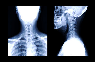 X-ray C-spine or x-ray image of Cervical spine AP and Lateral view for diagnostic intervertebral...
