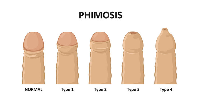 Types of phimosis. Vector illustration