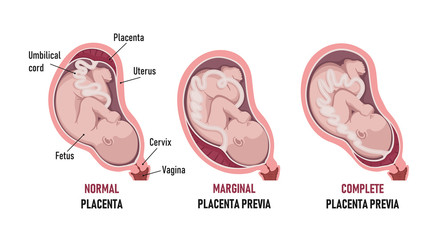Placenta previa: normal , Partial, Marginal (Low-lying), Complete