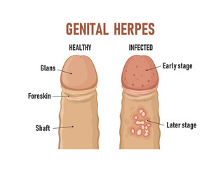 Genital herpes. Healthy penis and infected - obrazy, fototapety, plakaty