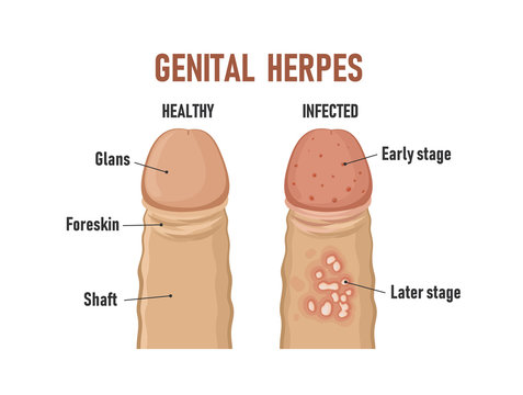 Genital herpes. Healthy penis and infected
