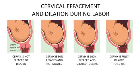 Cervix thinning and widening during labor - obrazy, fototapety, plakaty