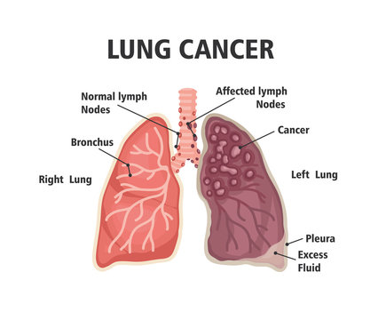 Comparison between healthy lung and cancer lung