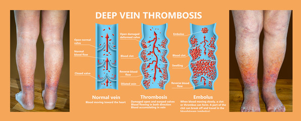 Close-up of skin with varicose veins