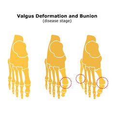 Age and valgus deformity of the thumb. Bunion. Stages of development of the disease. Silhouette of the foot bones.