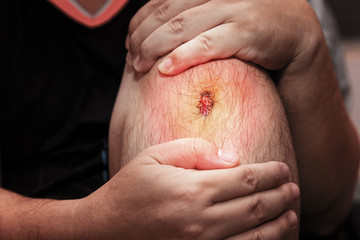 Closeup of fresh wound on man's knee from accident.