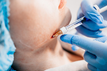 Contour plastics - injection rejuvenation by introducing into the middle layers of the skin filler preparations (fillers) based on hyaluronic acid - Lower jaw angles