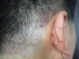 Closed up of ringworm (tinea) on head of asian man (Dermatitis)
