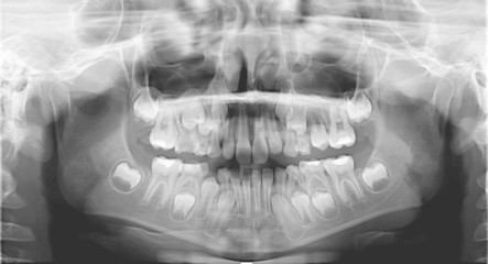 X-ray scan of children's jaw teeth. Panoramic negative image of the face of the child. The picture was taken for a dental diagnostic examination at a clinical examination.