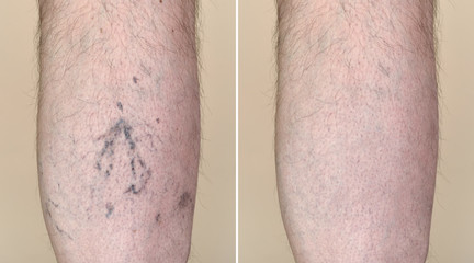 Part of a leg (calf) of the man with varicose veins and capillaries before and after medical...