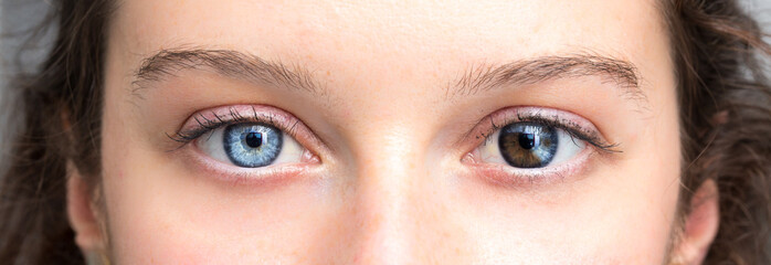Human heterochromia on eyes of girl, blue one and brown one