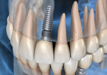 Central Incisor recovery by implant.  Medically accurate 3D illustration of dental concept