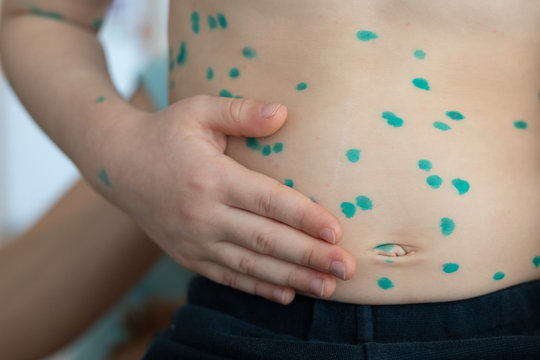 Little kid with small pox at the physical exam.