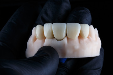 technician holding a model with dental crowns for the front teeth of the upper jaw on a black background © Dental Pro Content