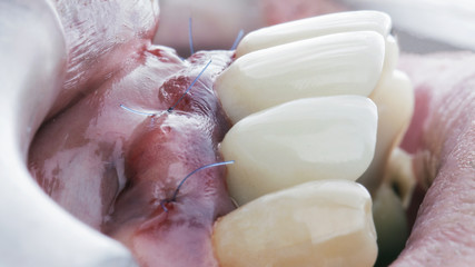 Clogged gums after installing two implants in the front areas of the oral cavity