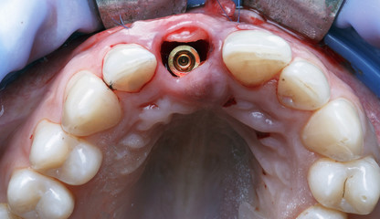 implant in the gum cavity of the anterior incisor, special dental photo