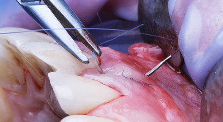 suture time during dental implantation