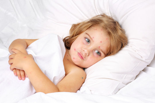 Chickenpox in a 3 year old boy lying in bed. Portrait, long hair, white clothes, background