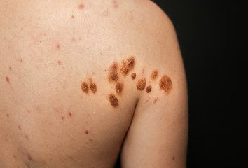 Big birthmarks and freckles on the girl's skin. Medical health photo of back. Woman's oily skin...