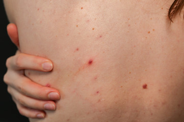 Many birthmarks on the girl's back. Medical health photo. Woman's oily skin with problems acne.