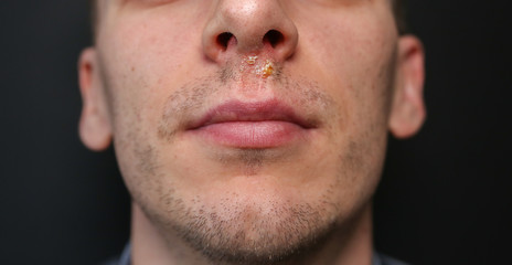 Herpes virus under the nose. Cold sore after the flu. Medical photo. Disease treatment.