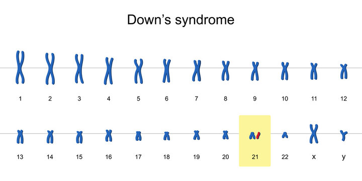 Down's syndrome karyotype